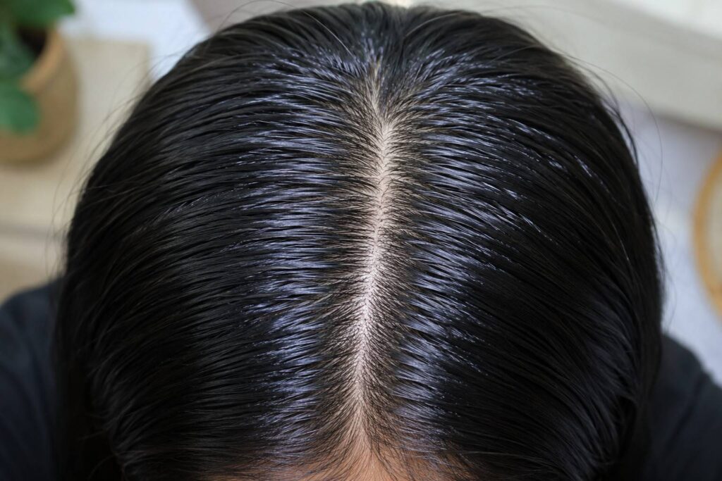 oily scalp and greasy roots in summer