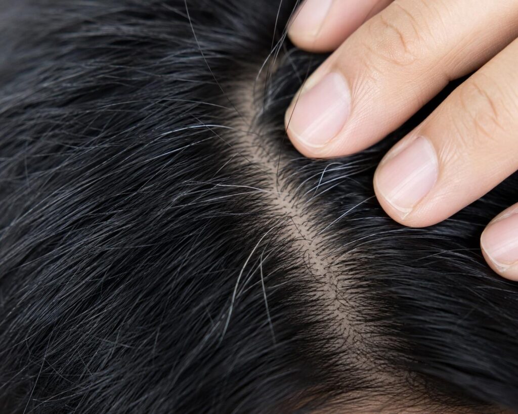  Premature grey hair caused by stress abroad