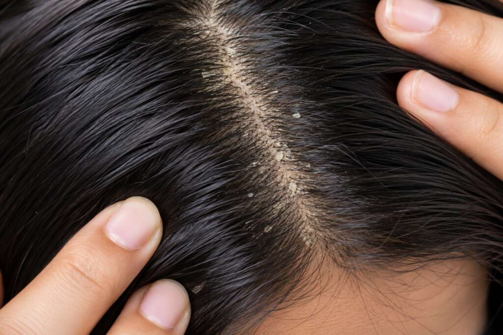 scalp buildup caused by sweat in summer